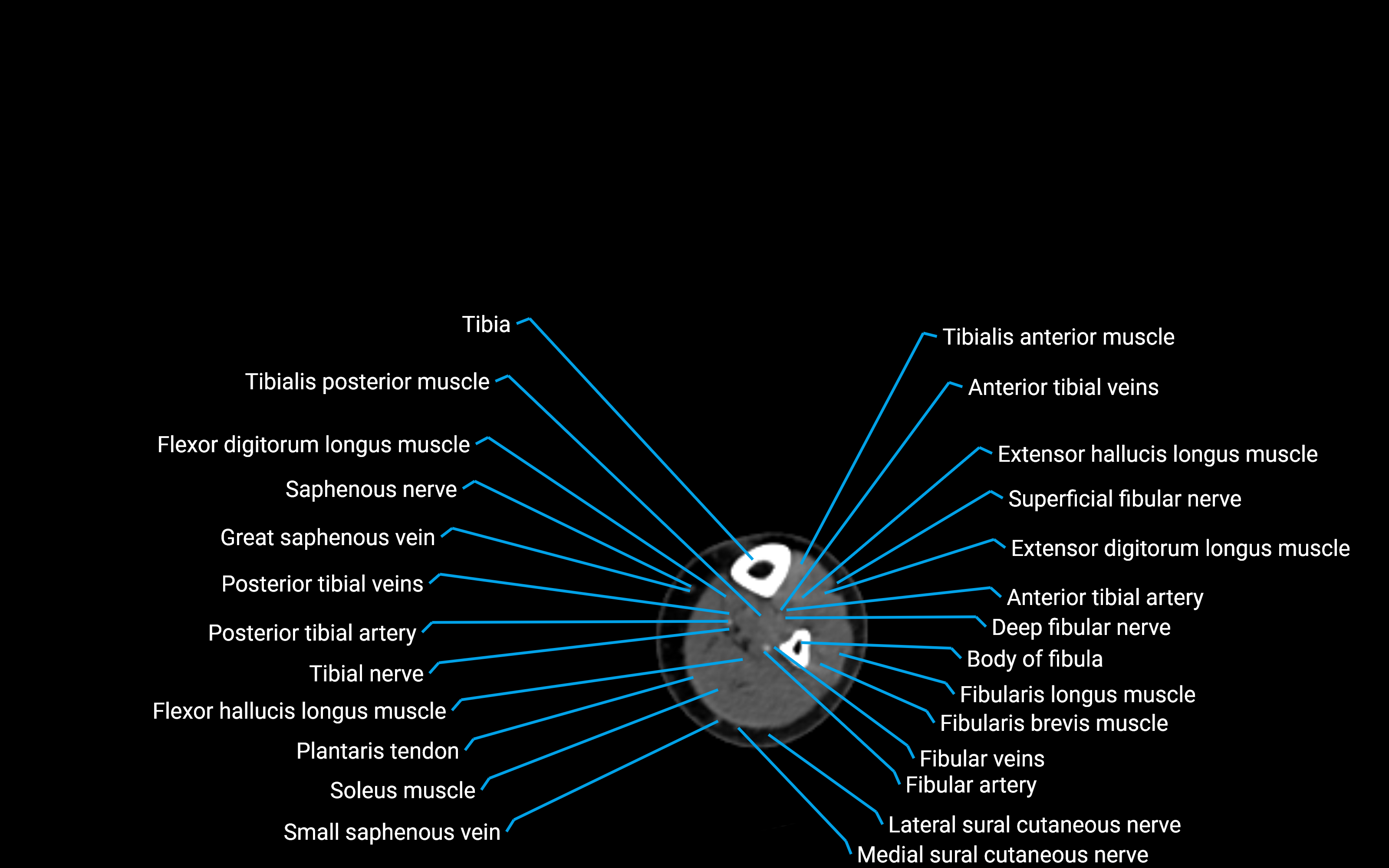 CT Lower leg axial cross sectional anatomy labelled image 136 (2).png